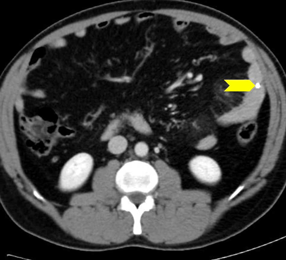 Small Bowel Vascular Angiodysplasia | Image | Radiopaedia.org