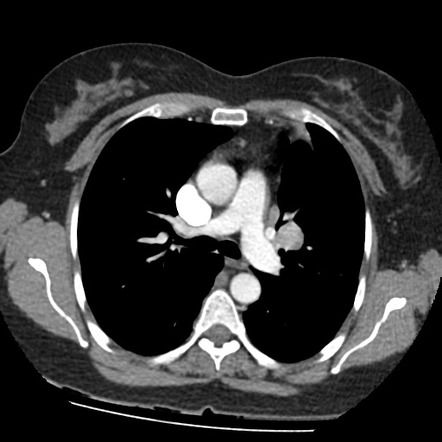 Bronchial carcinoid tumor | Radiology Reference Article | Radiopaedia.org