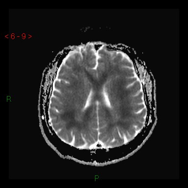 Acute toxic encephalopathy | Image | Radiopaedia.org