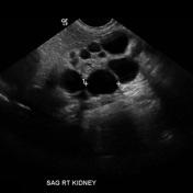 Multicystic Dysplastic Kidney | Radiology Reference Article ...