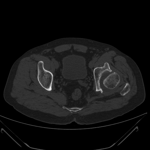 Pipkin fracture - type IV | Image | Radiopaedia.org