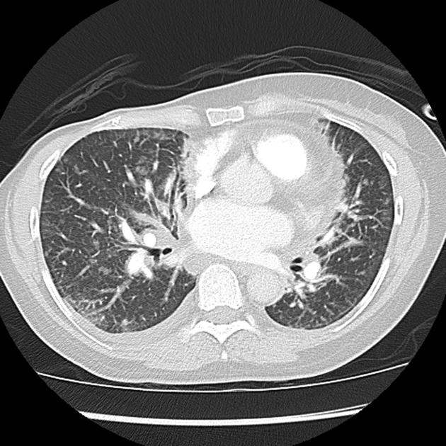 how-long-can-you-live-with-lung-cancer-spread-to-brain