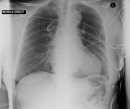 Aortic dissection - Stanford type B | Radiology Case | Radiopaedia.org