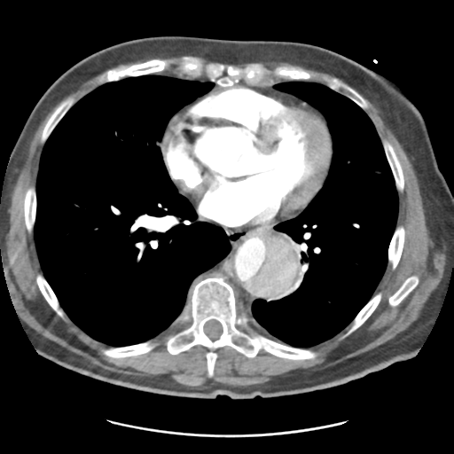 Aortic Dissection - Stanford Type B | Image | Radiopaedia.org