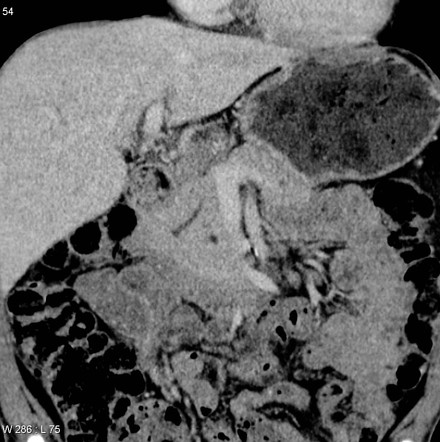 Pancreas divisum | Radiology Reference Article | Radiopaedia.org