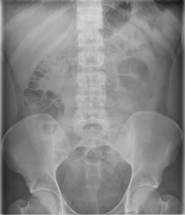 Acute appendicitis with appendicoliths | Radiology Case | Radiopaedia.org