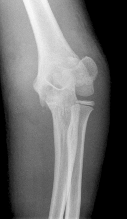 Supracondylar fracture | Image | Radiopaedia.org