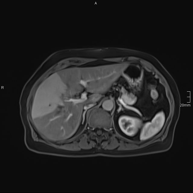 Transient Hepatic Attenuation Difference Secondary To Portal Vein