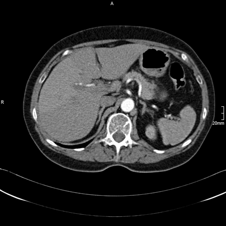 Transient hepatic attenuation difference secondary to portal vein ...