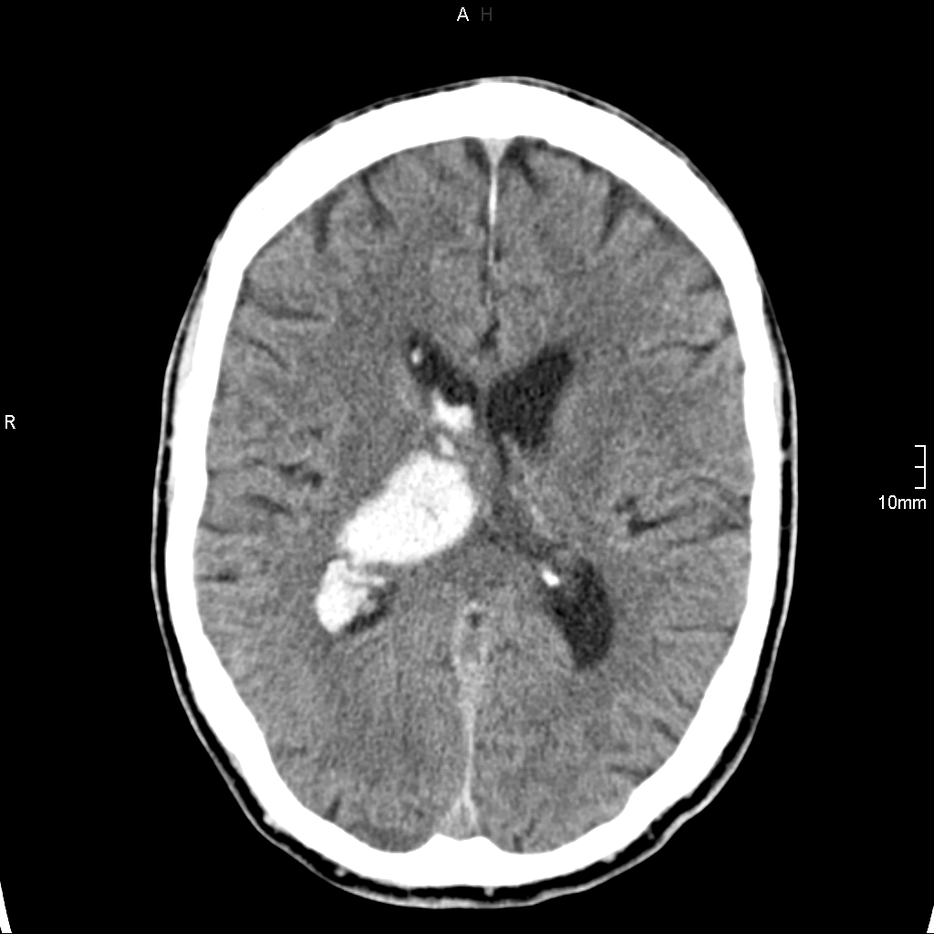 Hyperacute intracerebral hemorrhage on MRI and CT | Image | Radiopaedia.org