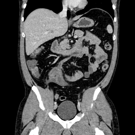 Small bowel carcinoid tumor | Image | Radiopaedia.org