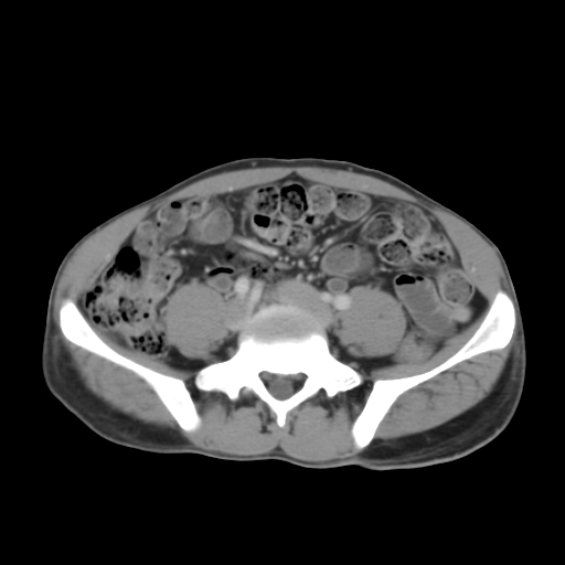 Bladder Diverticulum With Huge Calculus Image