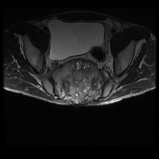 Sacrococcygeal chordoma | Image | Radiopaedia.org