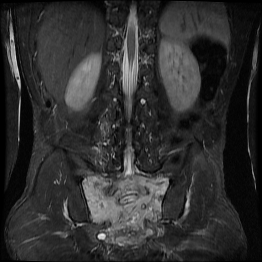 Sacrococcygeal chordoma | Image | Radiopaedia.org