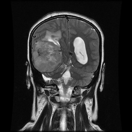 Dural Metastases | Image | Radiopaedia.org