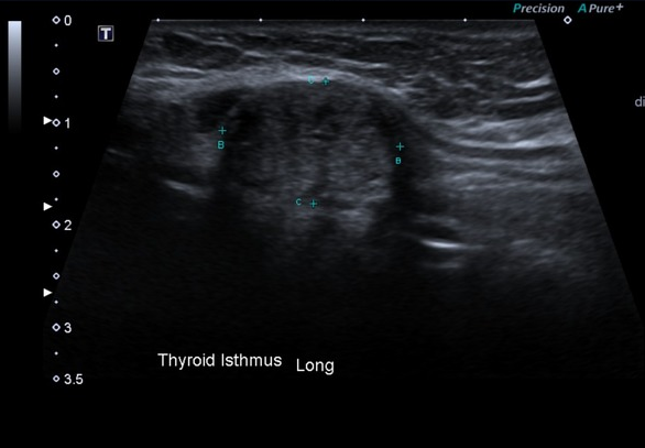 Papillary thyroid carcinoma | Image | Radiopaedia.org