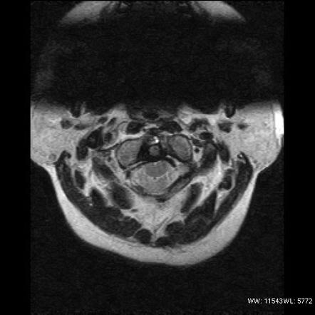 Atlanto-occipital assimilation | Image | Radiopaedia.org