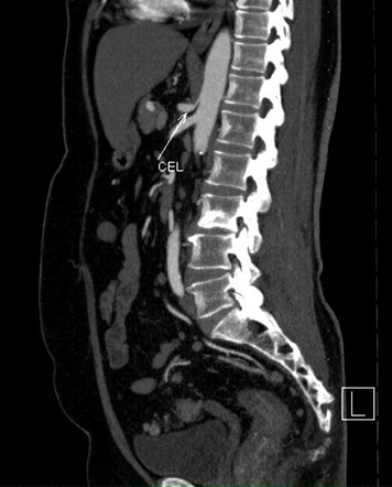 Renal and celiac artery stenosis | Image | Radiopaedia.org