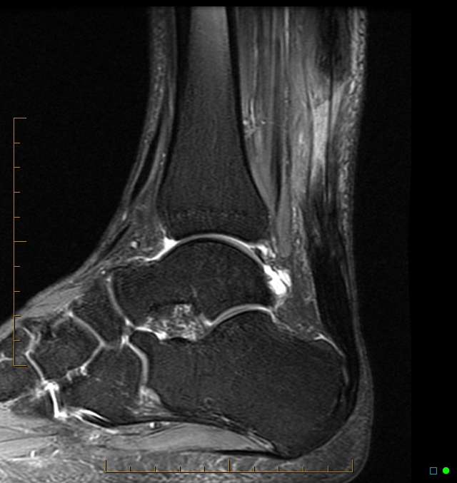 Chronic ruptured Achilles tendon with intact plantaris | Image ...