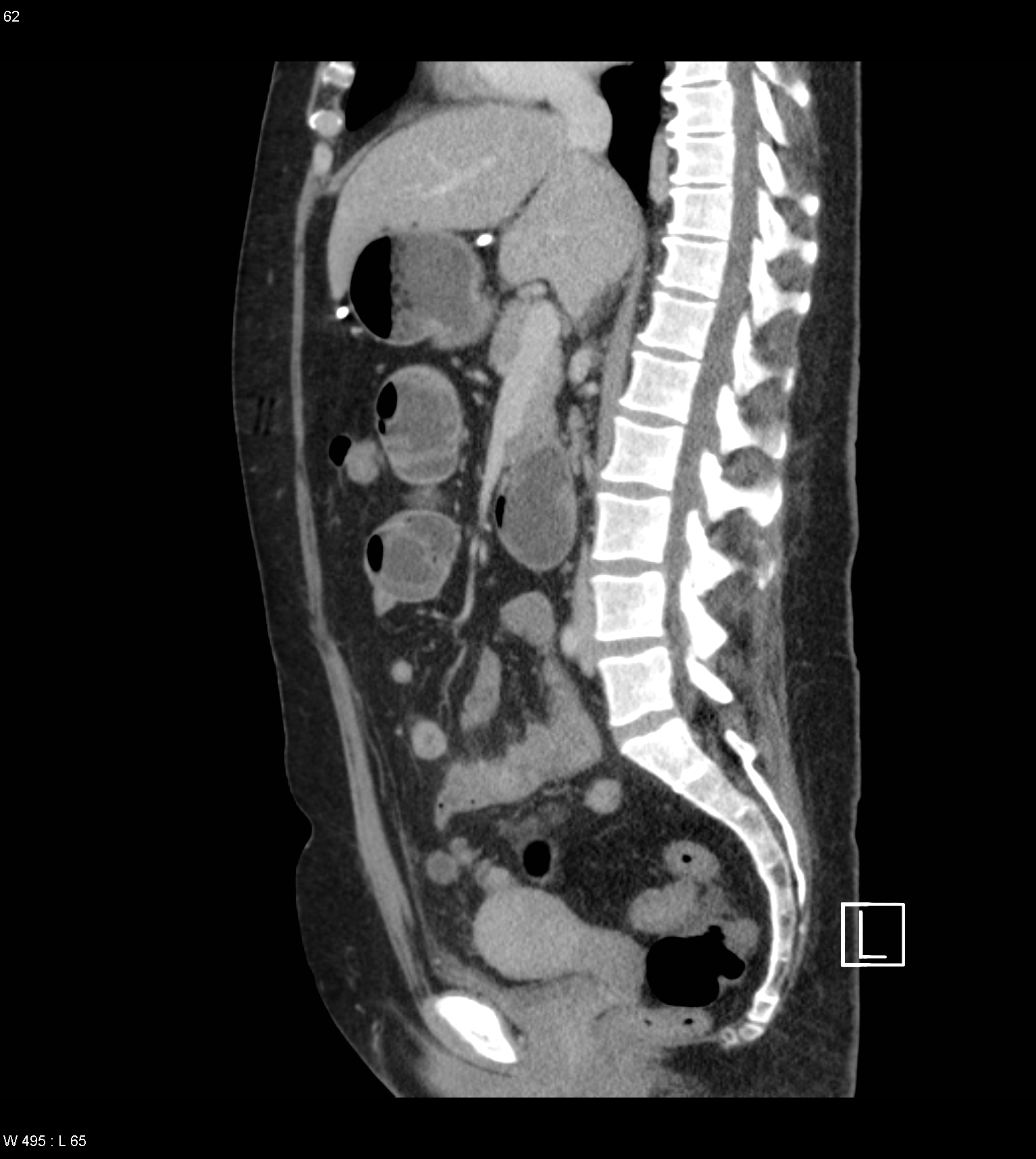 Small bowel obstruction due to endoluminal migration of a fractured ...