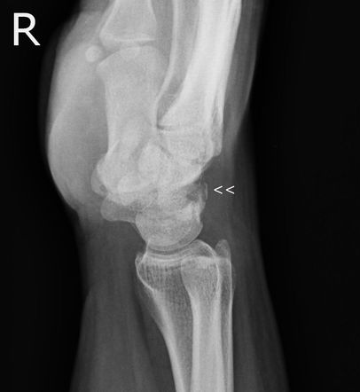 Triquetral fracture | Radiology Reference Article | Radiopaedia.org