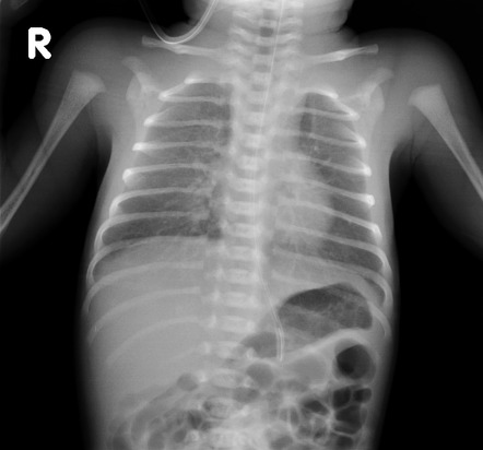 case study respiratory distress syndrome