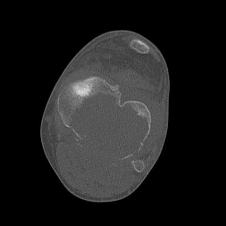 icd 10 code for pigmented villonodular synovitis left knee