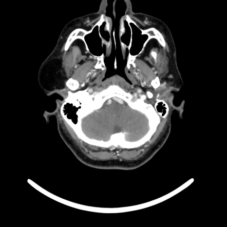 Parotid Lipoma Radiology Reference Article Radiopaedia Org