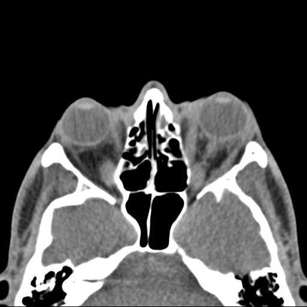 Bilateral ocular proptosis | Image | Radiopaedia.org