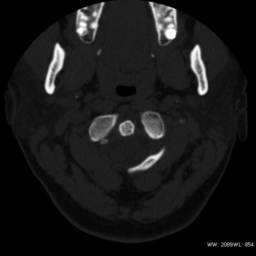 Atlanto-occipital assimilation | Image | Radiopaedia.org