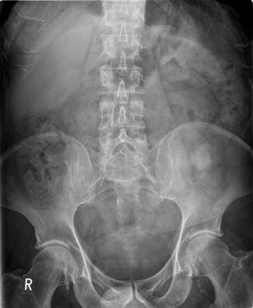 Penile prosthesis | Radiology Case | Radiopaedia.org