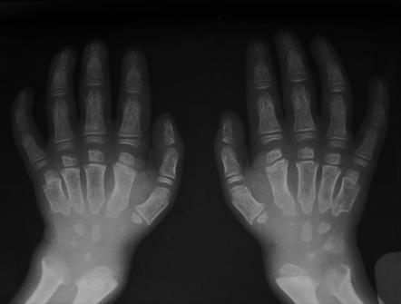 Morquio syndrome | Radiology Reference Article | Radiopaedia.org