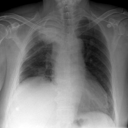 Phrenic Nerve Palsy Radiology Reference Article Radiopaedia Org