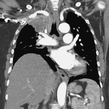 Phrenic nerve palsy | Radiology Reference Article | Radiopaedia.org