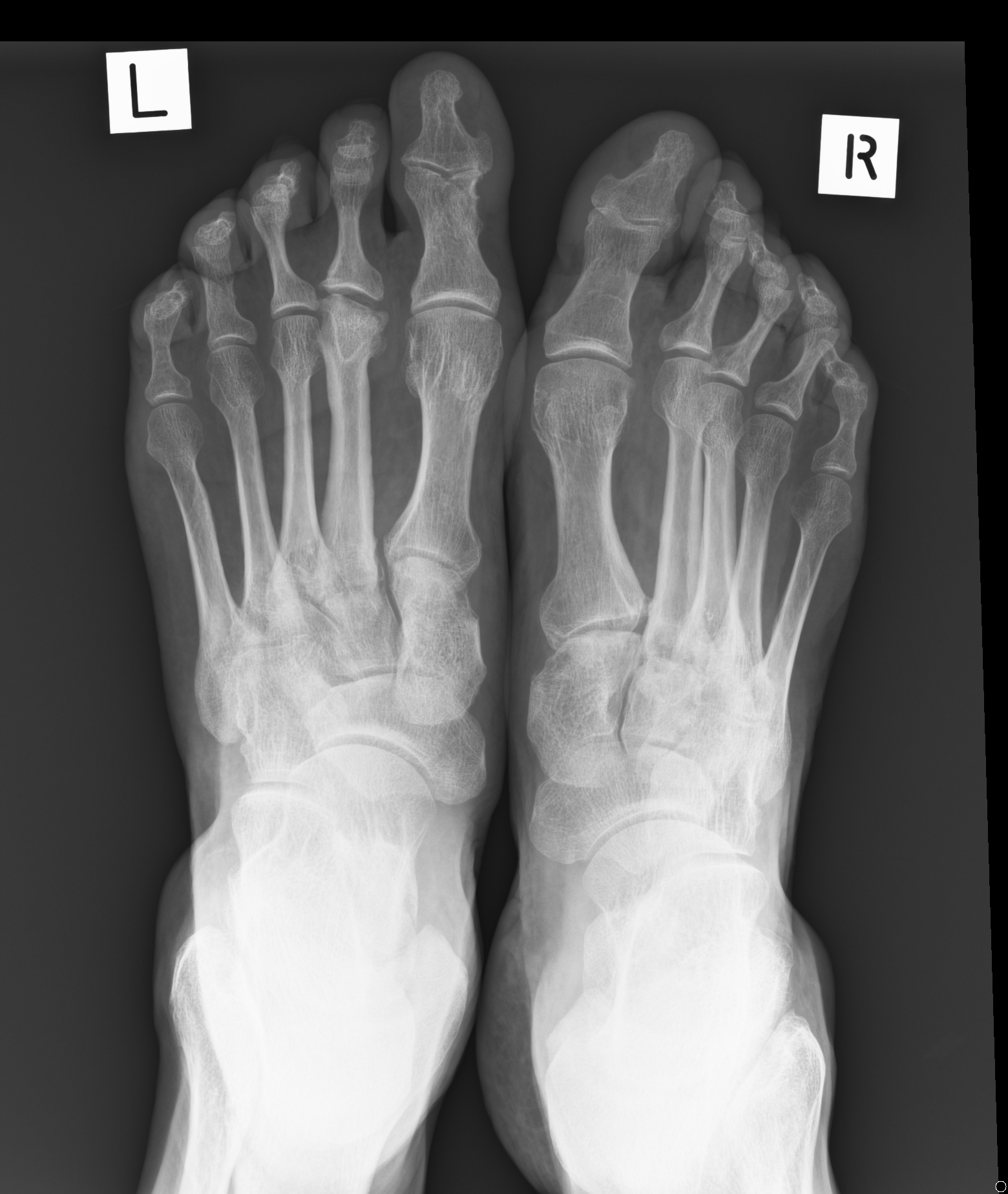 Freiberg infraction | Image | Radiopaedia.org