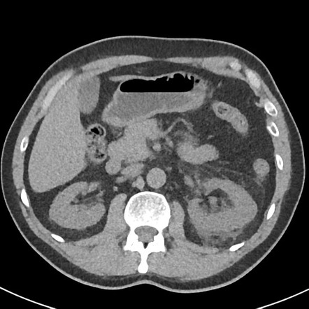 Renal forniceal rupture | Radiology Reference Article | Radiopaedia.org