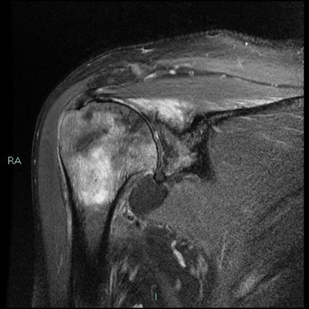 Lipoma arborescens (shoulder) | Image | Radiopaedia.org