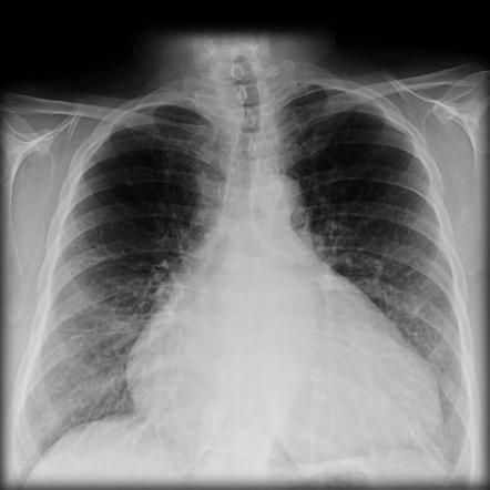 Cardiac myxoma | Radiology Reference Article | Radiopaedia.org