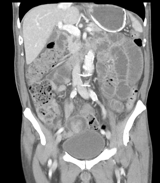 Ileoileal intussusception secondary to small bowel GIST | Image ...