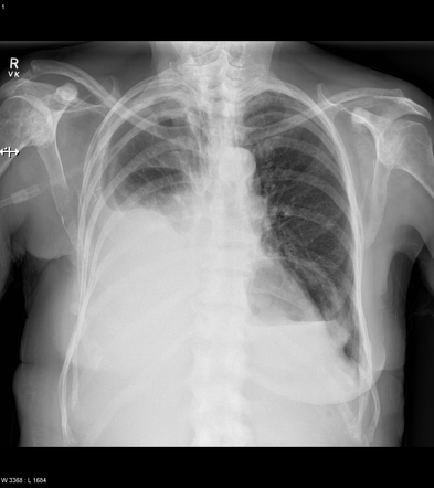 Malignant Pleural Effusion Due To Metastatic Breast Cancer Radiology