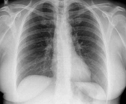 Lateral erosion of the clavicle | Radiology Case | Radiopaedia.org