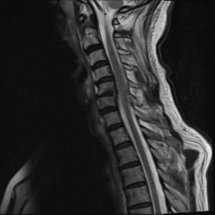 Vertebral metastases | Radiology Case | Radiopaedia.org