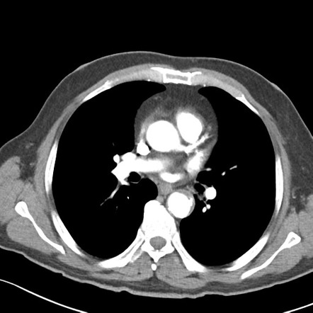 Vertebral metastases | Radiology Case | Radiopaedia.org