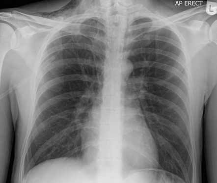 Pneumomediastinum | Radiology Case | Radiopaedia.org