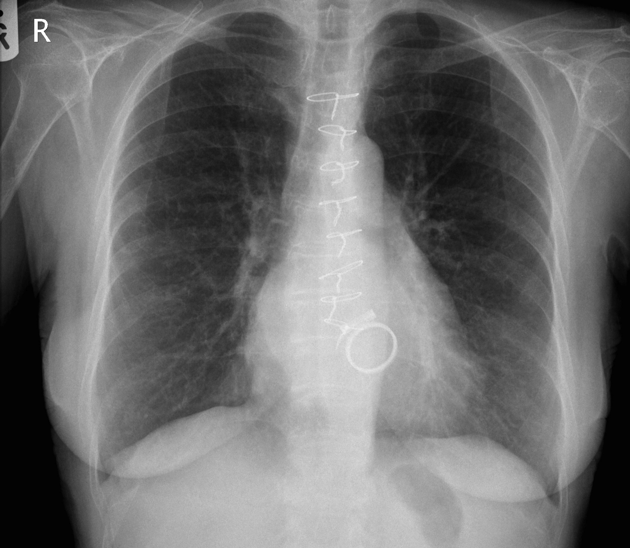 Bicuspid Aortic Valve Chest X Ray at Cheryl Franklin blog