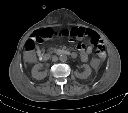 Supraumbilical omental fat herniation | Radiology Case | Radiopaedia.org