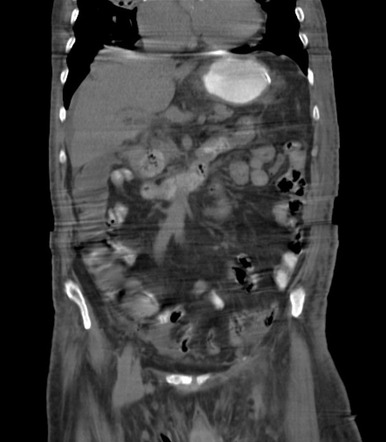 Supraumbilical omental fat herniation | Image | Radiopaedia.org