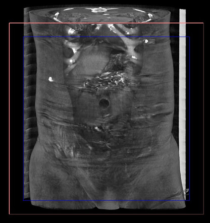 Supraumbilical omental fat herniation | Image | Radiopaedia.org