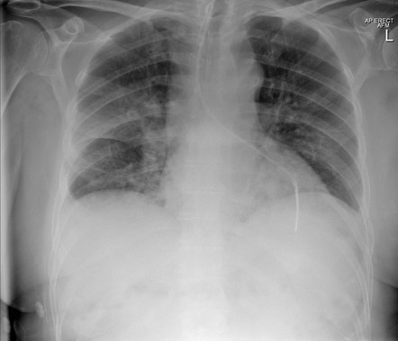 Nasogastric tube positioning | Radiology Reference Article ...