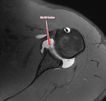 Glenolabral articular disruption lesion | Radiology Reference Article ...